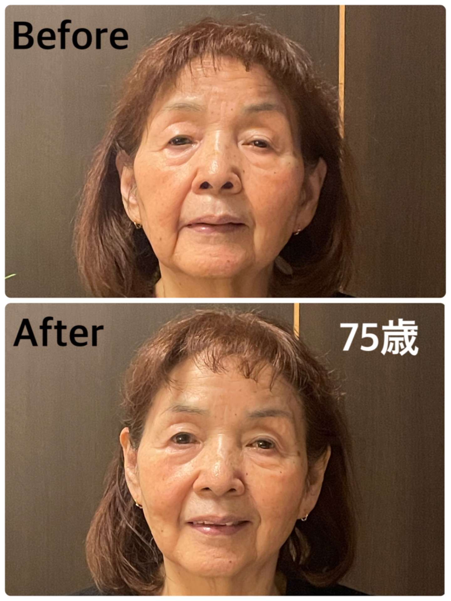 表情筋トレーニング 美容器 しわ、たるみ エステサロン 自体サロン 表情筋を鍛えた結果 | ブログ | 岐阜県多治見市のエステならsalon de